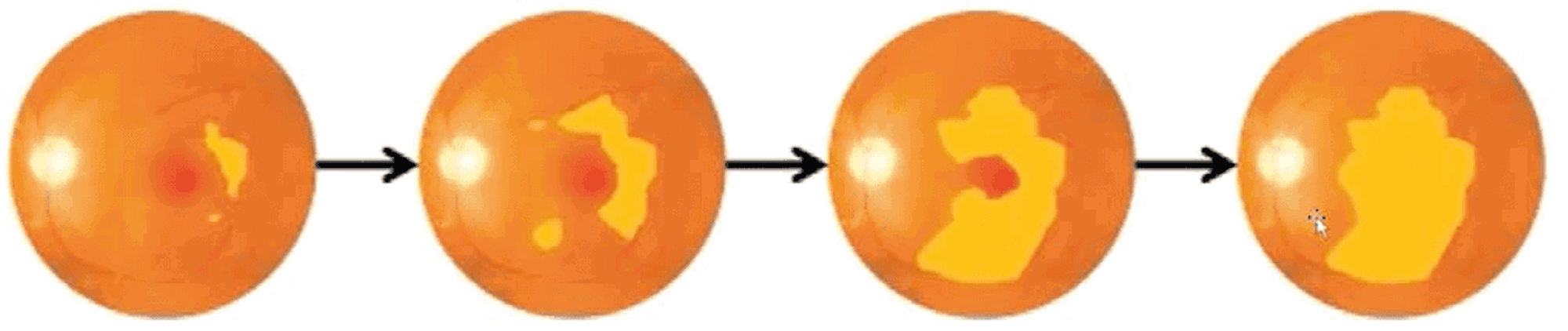 Diagram Of Atrophy Spreading